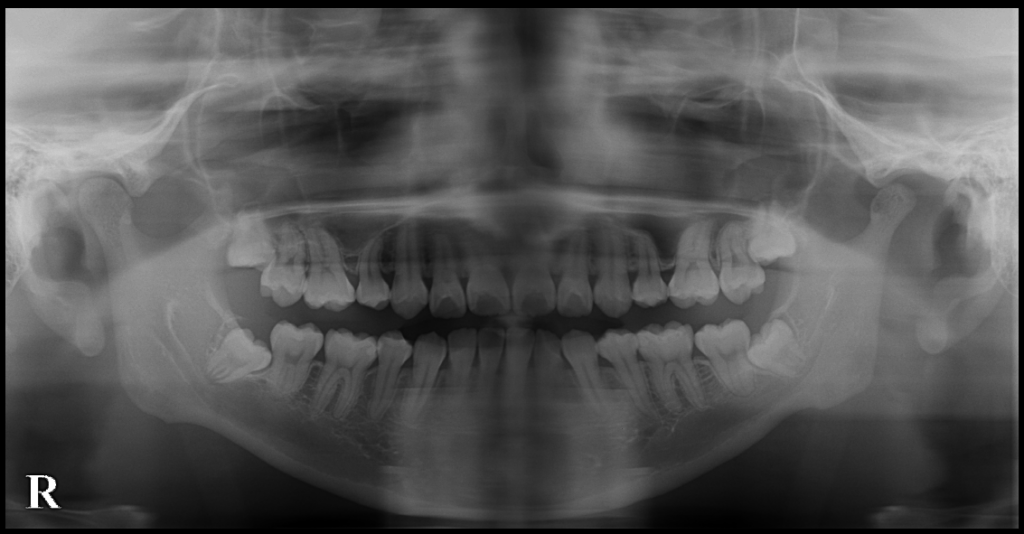 小臼歯を4本抜いて矯正してもスペースが足りず 親知らずも抜かないといけないケース こむら小児歯科 矯正歯科blog