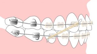 歯列矯正中（インビザライン）のゴムかけの効果、期間は？ | KOMURA BLOG