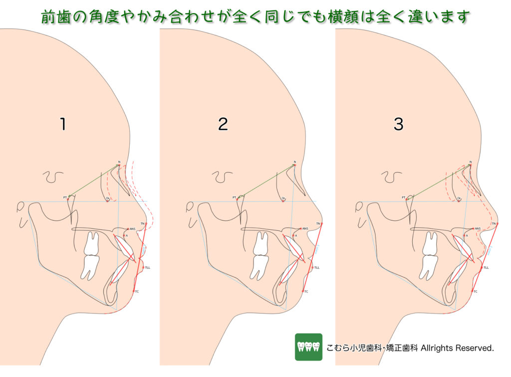 前歯の角度やかみ合わせが全く同じでも、横顔は全く違います。