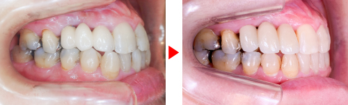 症例04矯正写真（右）、治療前→治療後