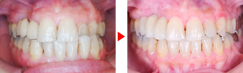 症例04矯正写真（前）、治療前→治療後