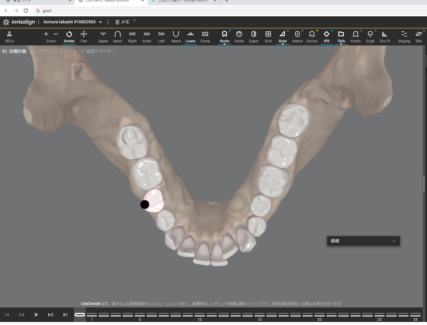 下顎の歯並び
