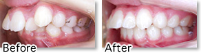 12才女性 下顎前歯欠如＋叢生＋過蓋咬合＋上顎前突